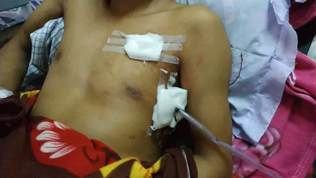 မြောက်ဦးကနေ စစ်တွေဆေးရုံကို ယူလာခဲ့ပြီး ကုသမှုခံယူနေရ