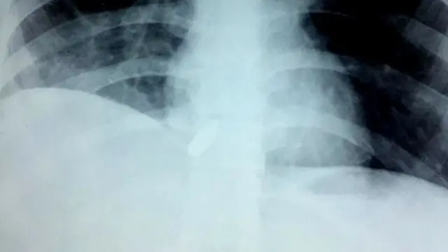 எக்ஸ் ரேவில் தெரியும் துப்பாக்கி தோட்டா