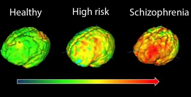 Brain scans have discovered higher activity levels in part of the brain's immune system in schizophrenia patients than in healthy volunteers