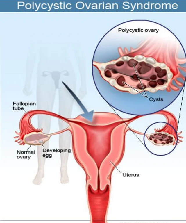 Ihe eserese na-egosi ọrịa PCOS