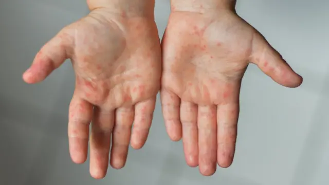 Duas mãos com as palmas para cima mostrando erupções cutâneas, pequenos pontinhos vermelhos