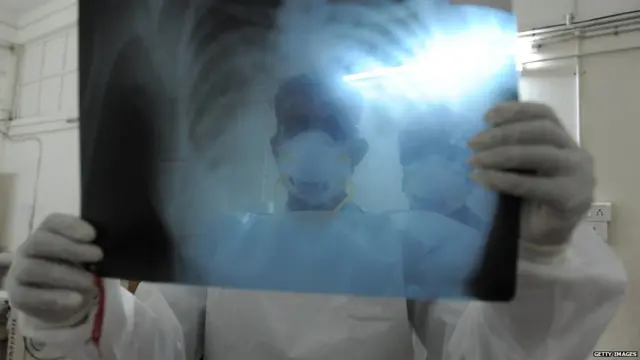 स्वाइन फ़्लू