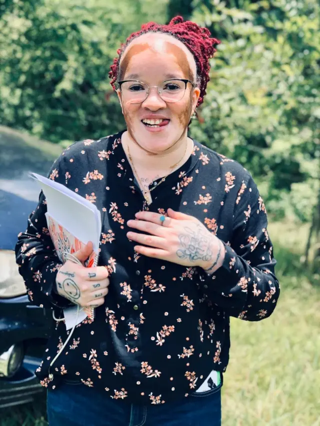 Njee Wangoi ni mtetezi wa watu wanaoishi na hali ya vitiligo