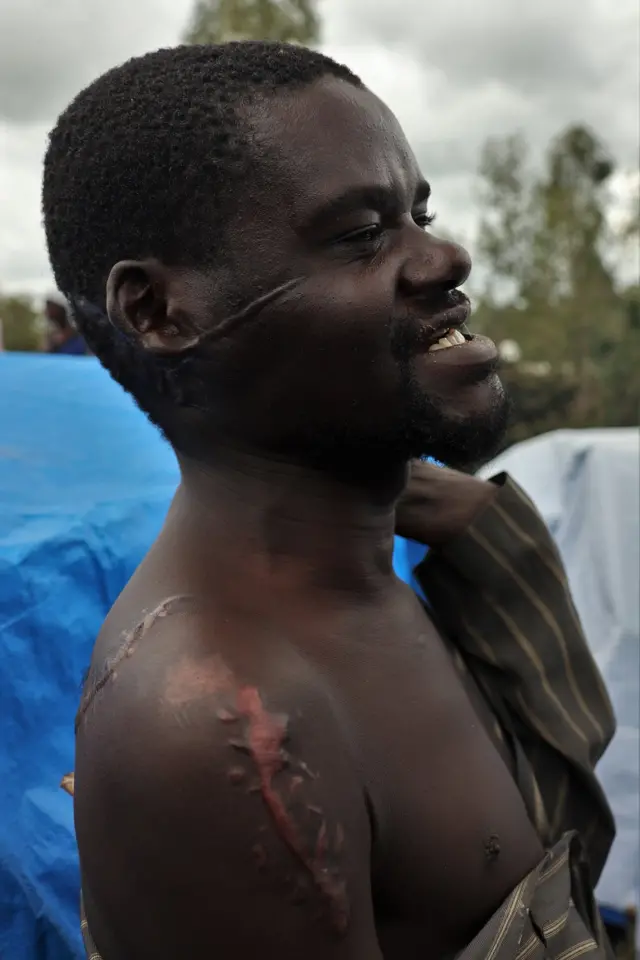 Un homme avec des citatrices de machette sur son visage et ses épaules.