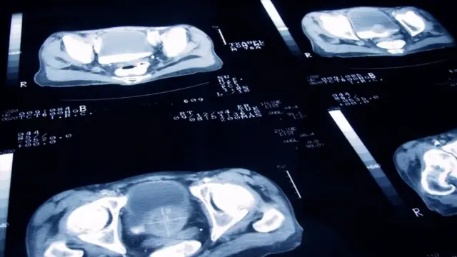 Трансродне и небинарне особе могу бити позване на претраге и прегледе који им нису потребни, док пропуштају друге