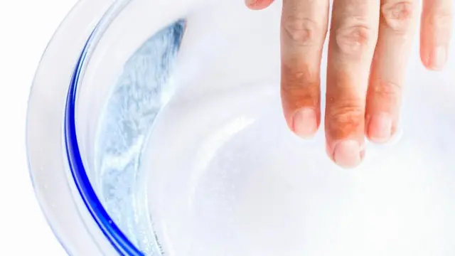 Una persona mete sus dedos con quemaduras en un bol de agua fría