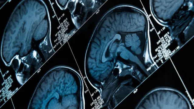 Resultados de exame cerebral