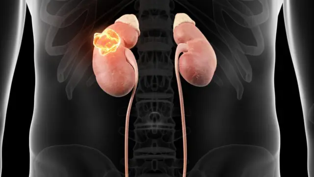 سرطان الكلى