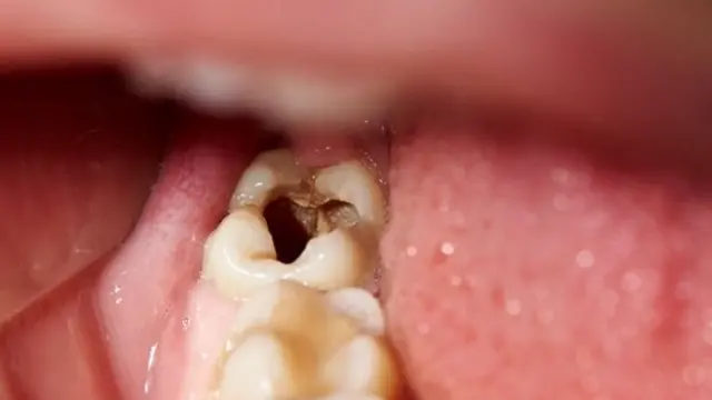 Baadhi ya bakteria hupungua na wengine kuongezeka na hivyobasi kusababisha ukosefu wa usawa