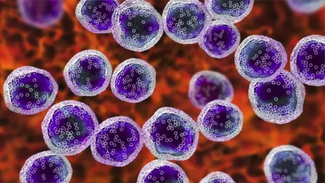 Dalili ni pamoja na uvimbe wa tezi za limfu, haswa katika sehemu ya mwili ambapo saratani ya matezi huanza kukua.