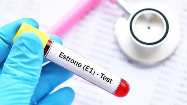 ఓవరియన్ హైపర్ స్టిమ్యులేషన్ సిండ్రోం నిర్థరణకు ఈస్ట్రోజెన్ పరీక్ష చేయించుకోవాల్సి ఉంటుంది