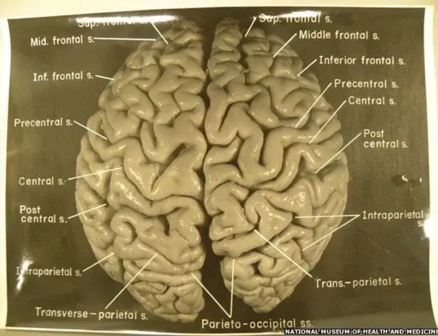 આઇન્સ્ટાઇનના મગજની તસવીર