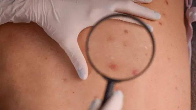 தோல் புற்றுநோய் யாருக்கெல்லாம் ஏற்படும்? அறிகுறிகள் என்ன?