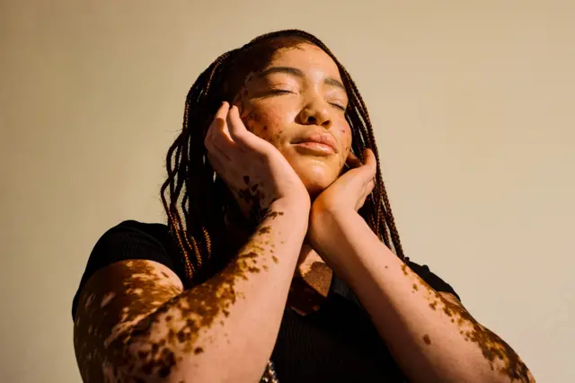 Una mujer con vitiligo, una enfermedad que afecta la melanina de la piel.