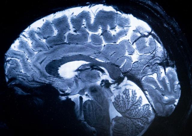 Uma imagem do cérebro por ressonância magnética