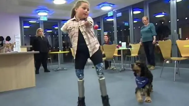 కంప్యూటరైజ్డ్ కృత్రిమ కాళ్ళు