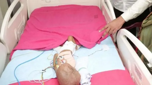 குழந்தைக்கு வலது கை அகற்றம் ஏன்?