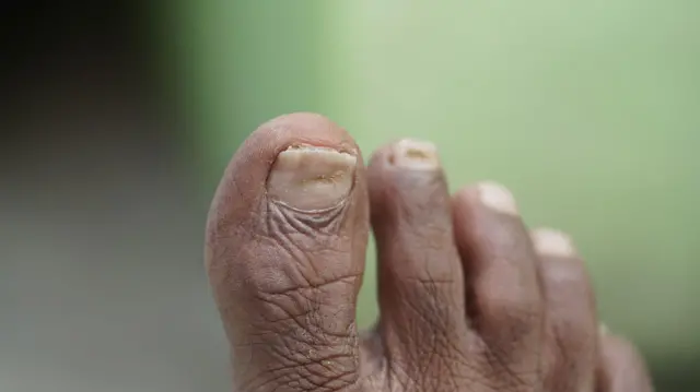 ਫੰਗਲ ਇੰਫੈਸ਼ਨ