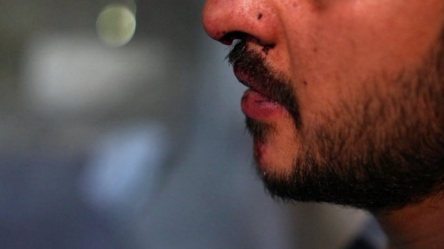 Photo of Man with a bloody nose and beard only visible from nose down