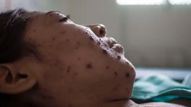 A woman with measles rash on her face lies in bed in Brazil