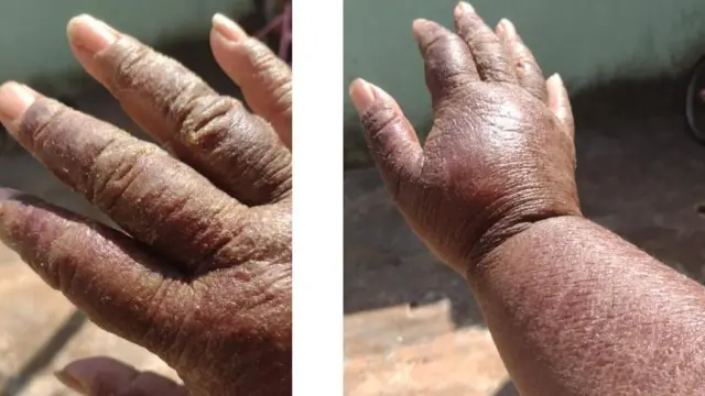 लिलिअनको एलर्जी