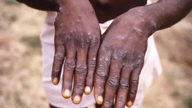 Onye na-arịa ọrịa Mpox