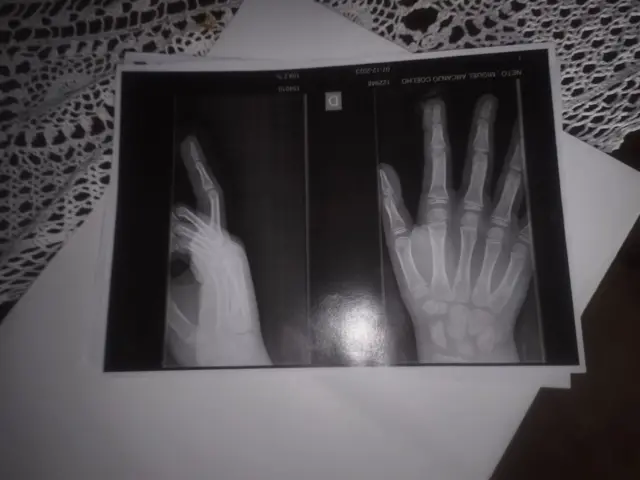 Foto mostra raio-x tirado por Miguel após incidente na escola