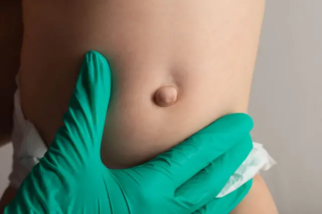 जन्मजात असलेला हर्निया