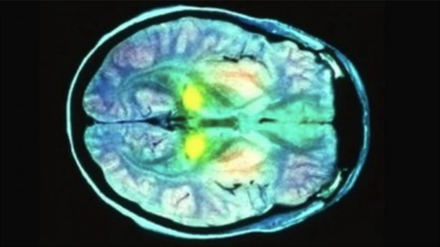 A brain scan showing part of the brain highlighted yellow