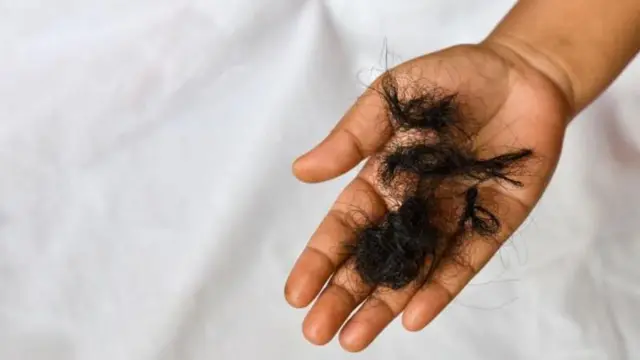 முடி உதிர்தல் பிரச்னை, கட்டுக்கதையும் உண்மையும்