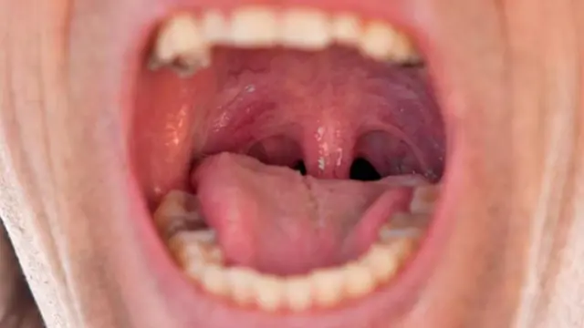 ਟੌਨਸਿਲ ਸਟੋਨ