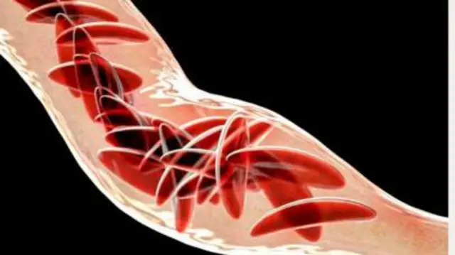 सिकल सेल अॅनिमिया