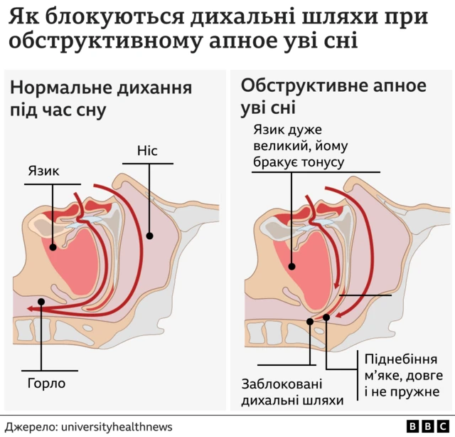 апное уві сні