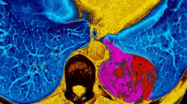 Дагы бир изилдөө витаминдик кошулмалар бизди оорудан коргобостон, тамеки чеккендердин өпкө рагына чалдыгууларын көбөйтөрүн көрсөткөн.