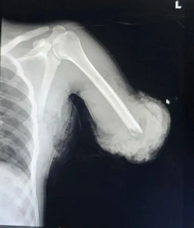 Ishusho ya X-ray y'akaboko k'uyu musore kari kacitse