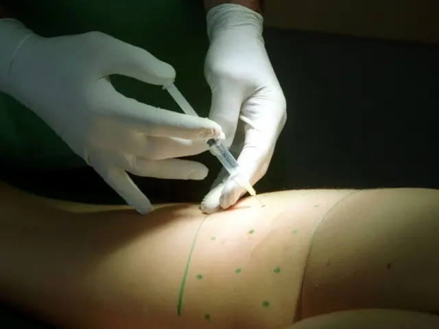 लिपोसक्शन