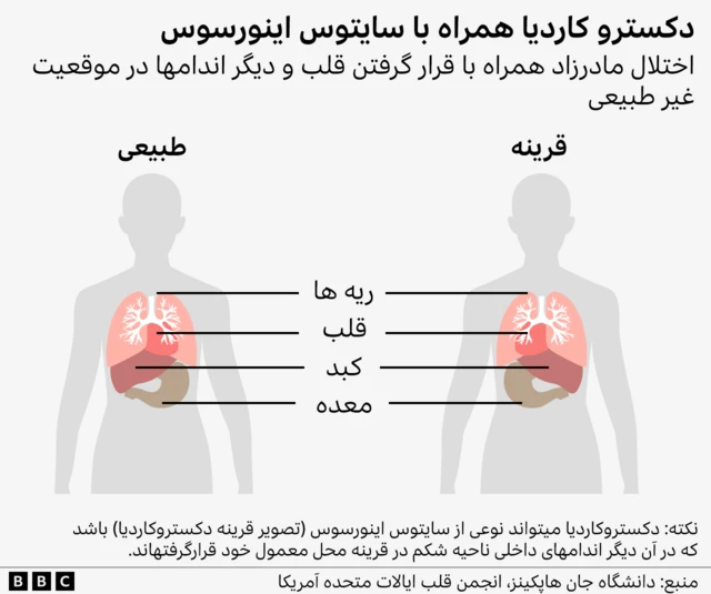 تصویرسازی از محل قرار گرفتن قلب، کبد، معده و کلیه در حالت طبیعی و در حالت قرینه