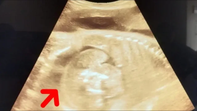 ਫੀਟਸ ਇਨ ਫੀਟੂ ਦੇ ਮਾਮਲੇ ਘੱਟ ਹੀ ਦੇਖਣ ਨੂੰ ਮਿਲਦੇ ਹਨ 