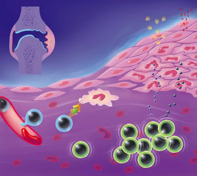 కీళ్ల వాపు