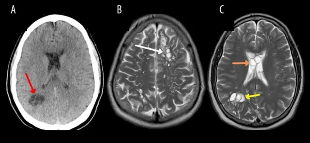 Imágenes de escáneres cerebrales