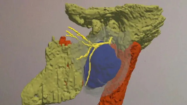 El holograma mostrando el tumor y el nervio facial