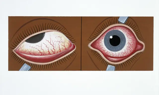 மெட்ராஸ் ஐ