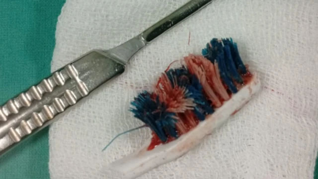 గొంతు, వస్తువులు, టూత్ బ్రష్, పళ్లు, శ్రీలంక