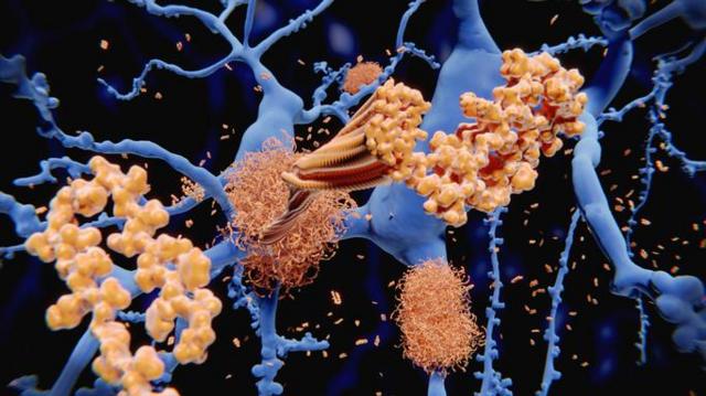 Acúmulo de beta-amiloide entre os neurônios