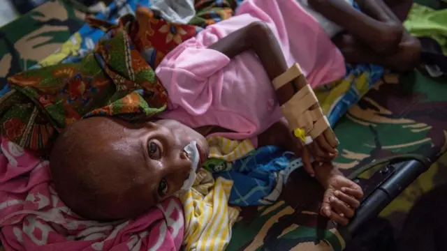 Gizi buruk, Asmat, Papua Selatan, Dana Otsus Papua, krisis kesehatan