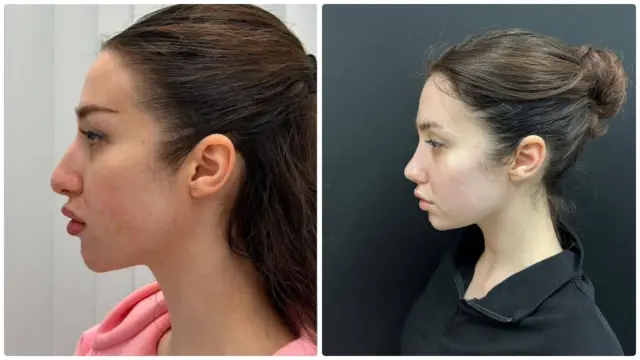 Диана в профиль: до и после пластики