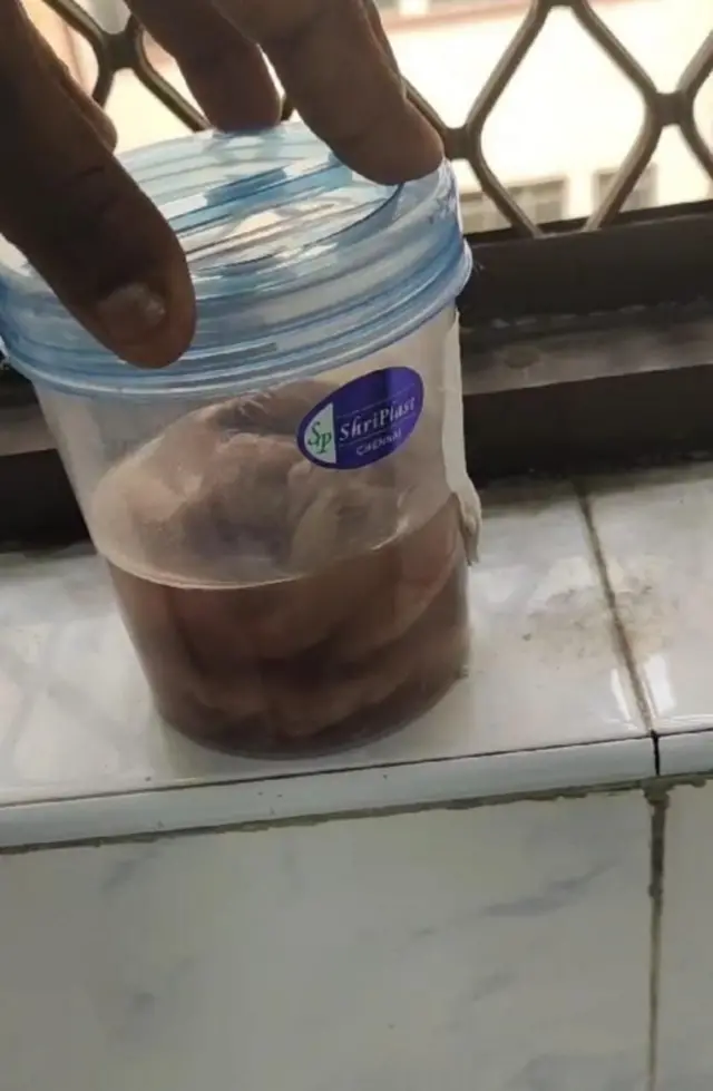 బ్యాండేజ్ పొట్టలో ఉంచి ఆపరేషన్