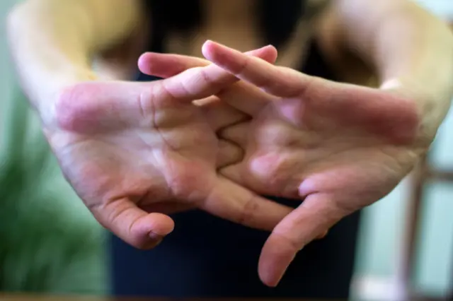 சொடக்கு, ஆர்த்ரிட்டிஸ்