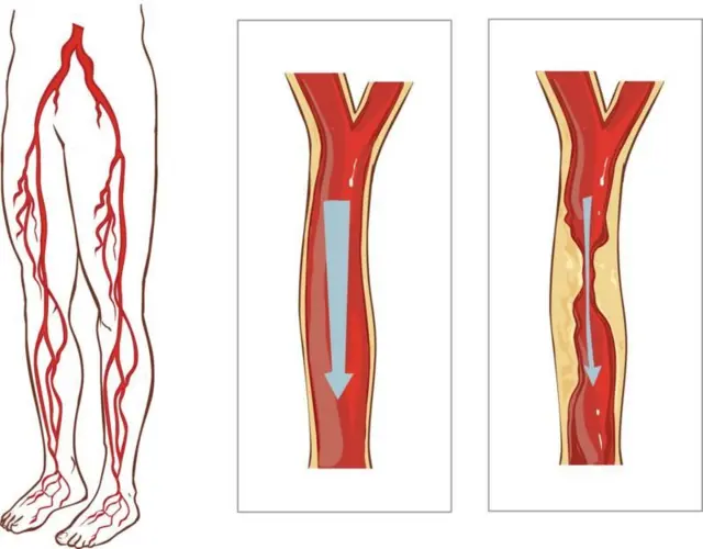 Lorsque le muscle se contracte, il compacte les veines et ramène le sang vers le cœur.