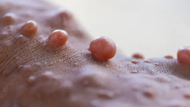 న్యూరోఫైబ్రోమాటోసిస్ 